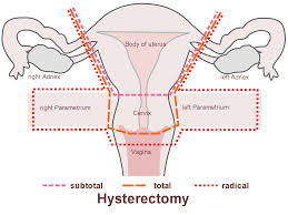 How long do I need to wait to have sex after hysterectomy? Will sex be